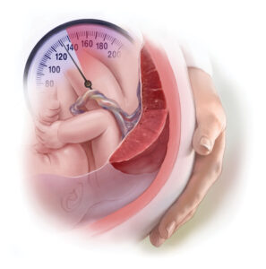 فشار خون بارداری  علائم مسمویت بارداری است.