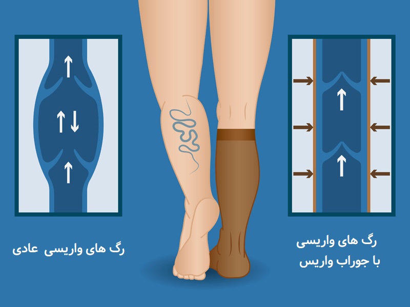 تاثیر جوراب واریس روی رگ ها